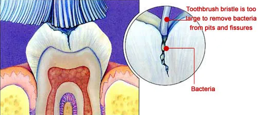 Featured image for “What Are Sealants?”